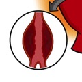 Oggi parliamo di... PATOLOGIA ANEURISMATICA